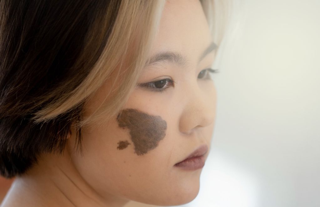 What Do Birthmarks Mean In The Bible?